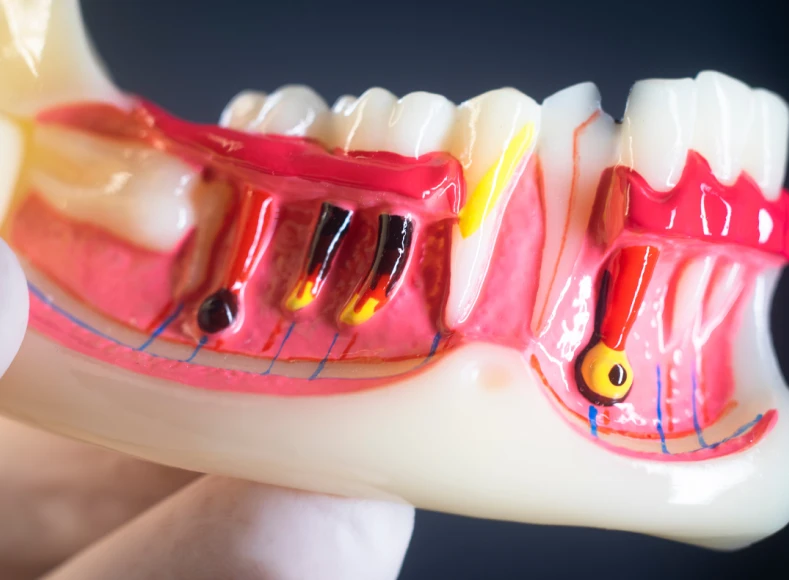 cirurgia apical ocorre próximo a raiz do dente