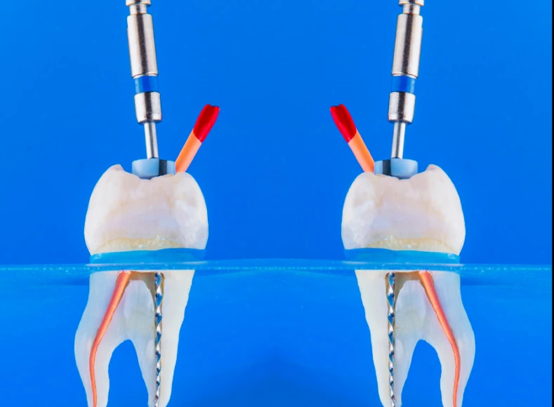 retratamento de canal dentário
